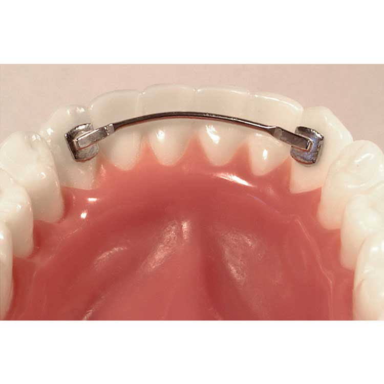 LB032 Dental Lingual Bars